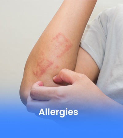Allergies