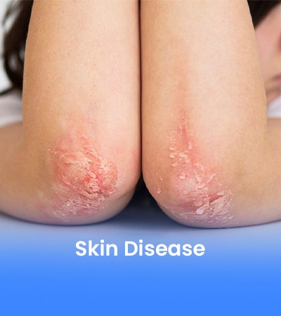 Skin Disease