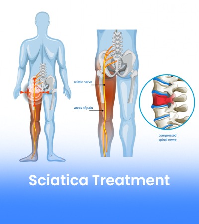 Sciatica Treatment